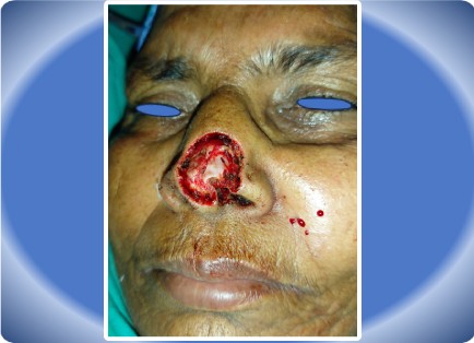 BASAL CELL CARCINOMA